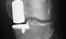 膝关节置换手术视频,从术前准备到术后康复